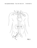 Methods of Transvascular Retrograde Access Placement and Devices for     Facilitating the Placement diagram and image