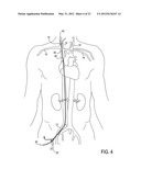 Methods of Transvascular Retrograde Access Placement and Devices for     Facilitating the Placement diagram and image