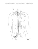 Methods of Transvascular Retrograde Access Placement and Devices for     Facilitating the Placement diagram and image