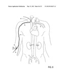 Methods of Transvascular Retrograde Access Placement and Devices for     Facilitating the Placement diagram and image