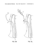 Methods of Transvascular Retrograde Access Placement and Devices for     Facilitating the Placement diagram and image