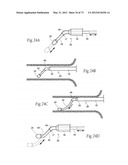 CATHETER APPARATUSES, SYSTEMS, AND METHODS FOR RENAL NEUROMODULATION diagram and image