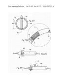 CATHETER APPARATUSES, SYSTEMS, AND METHODS FOR RENAL NEUROMODULATION diagram and image