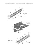 CATHETER APPARATUSES, SYSTEMS, AND METHODS FOR RENAL NEUROMODULATION diagram and image