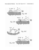 CATHETER APPARATUSES, SYSTEMS, AND METHODS FOR RENAL NEUROMODULATION diagram and image