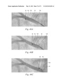 CATHETER APPARATUSES, SYSTEMS, AND METHODS FOR RENAL NEUROMODULATION diagram and image