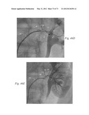 CATHETER APPARATUSES, SYSTEMS, AND METHODS FOR RENAL NEUROMODULATION diagram and image