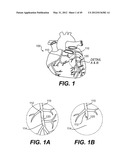 ENDOVASCULAR DEVICES AND METHODS FOR EXPLOITING INTRAMURAL SPACE diagram and image