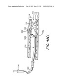 ENDOVASCULAR DEVICES AND METHODS FOR EXPLOITING INTRAMURAL SPACE diagram and image