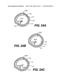 ENDOVASCULAR DEVICES AND METHODS FOR EXPLOITING INTRAMURAL SPACE diagram and image