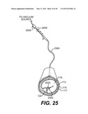 ENDOVASCULAR DEVICES AND METHODS FOR EXPLOITING INTRAMURAL SPACE diagram and image