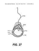 ENDOVASCULAR DEVICES AND METHODS FOR EXPLOITING INTRAMURAL SPACE diagram and image