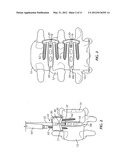 System and Method for Stabilizing Vertebrae in Spine Surgery Through a     Lateral Access Channel diagram and image