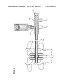 Interspinous Process Spacer Diagnostic Parallel Balloon Catheter and     Methods of Use diagram and image