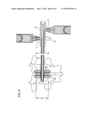 Interspinous Process Spacer Diagnostic Parallel Balloon Catheter and     Methods of Use diagram and image