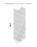 Helical Stent Design diagram and image