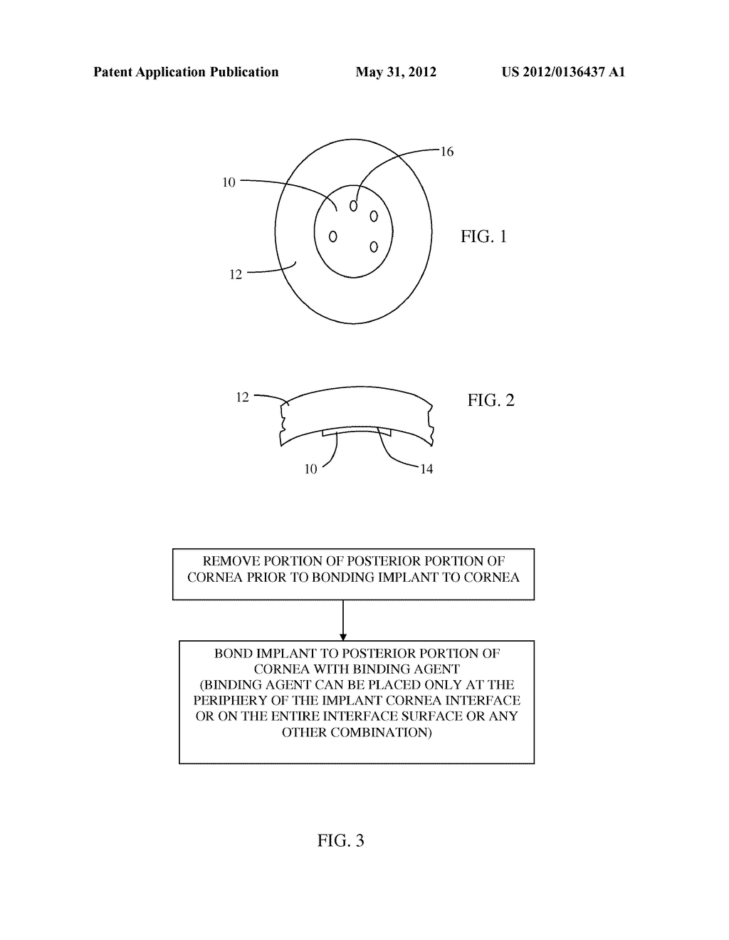 HYDROPHOBIC PSEUDO-ENDOTHELIAL IMPLANTS FOR TREATING CORNEAL EDEMA - diagram, schematic, and image 02