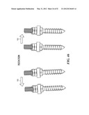 POSTERIOR SPINAL ARTHROPLASTY SYSTEM diagram and image