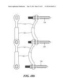 POSTERIOR SPINAL ARTHROPLASTY SYSTEM diagram and image