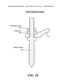 POSTERIOR SPINAL ARTHROPLASTY SYSTEM diagram and image