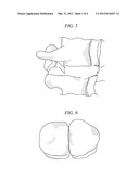 PROSTHESES FOR SPINE DISCS HAVING FUSION CAPABILITY diagram and image