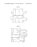 PROSTHESES FOR SPINE DISCS HAVING FUSION CAPABILITY diagram and image