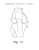 BONE PROTECTOR, KIT AND METHOD diagram and image