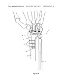 WRIST PROSTHESIS diagram and image