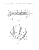 WRIST PROSTHESIS diagram and image