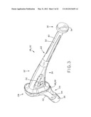 PROSTHETIC HIP IMPLANTS diagram and image