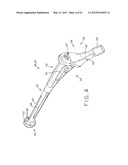 PROSTHETIC HIP IMPLANTS diagram and image