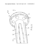 PROSTHETIC HIP IMPLANTS diagram and image