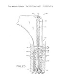 PROSTHETIC HIP IMPLANTS diagram and image