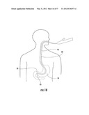 PYLORIC VALVE DEVICES AND METHODS diagram and image