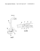 PYLORIC VALVE DEVICES AND METHODS diagram and image