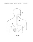 PYLORIC VALVE DEVICES AND METHODS diagram and image