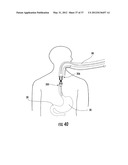 PYLORIC VALVE DEVICES AND METHODS diagram and image