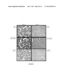 Biomarkers for Follicular Thyroid Carcinoma and Methods of Use diagram and image