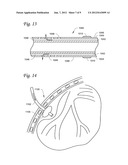 SYSTEMS AND METHODS FOR IMPAIRING SMOOTH MUSCLE TISSUE FUNCTION diagram and image