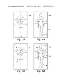 DEVICE AND METHOD FOR TREATING NOCTURIA diagram and image