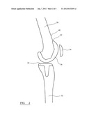 FEMORAL SIZING INSTRUMENT diagram and image