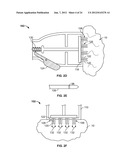 METHODS AND DEVICES FOR TREATING TISSUE diagram and image