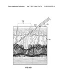 METHODS AND DEVICES FOR TREATING TISSUE diagram and image