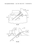 METHODS AND DEVICES FOR TREATING TISSUE diagram and image