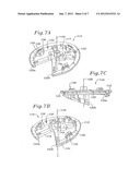 THREE-DIMENSIONAL ANNULOPLASTY RING diagram and image