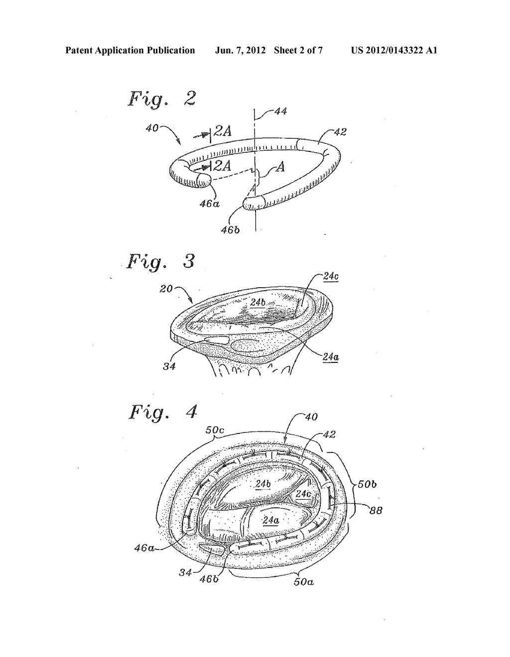 THREE-DIMENSIONAL ANNULOPLASTY RING - diagram, schematic, and image 03