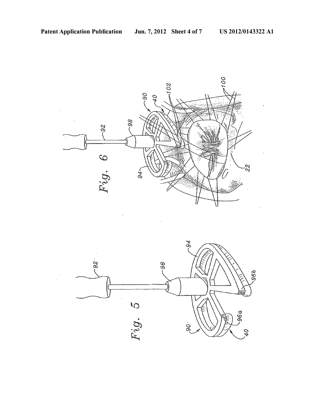 THREE-DIMENSIONAL ANNULOPLASTY RING - diagram, schematic, and image 05