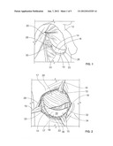 Prosthetic Support diagram and image