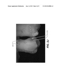 METHOD FOR IDENTIFICATION OF DENTAL CARIES IN POLYCHROMATIC IMAGES diagram and image