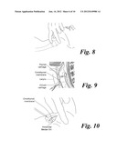 VIDEO CRICOTHYROTOMY CAMERA AND CANNULA SYSTEM diagram and image